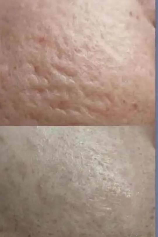 Skin Cell Scar Treatment Skin Cell Scar Treatment
