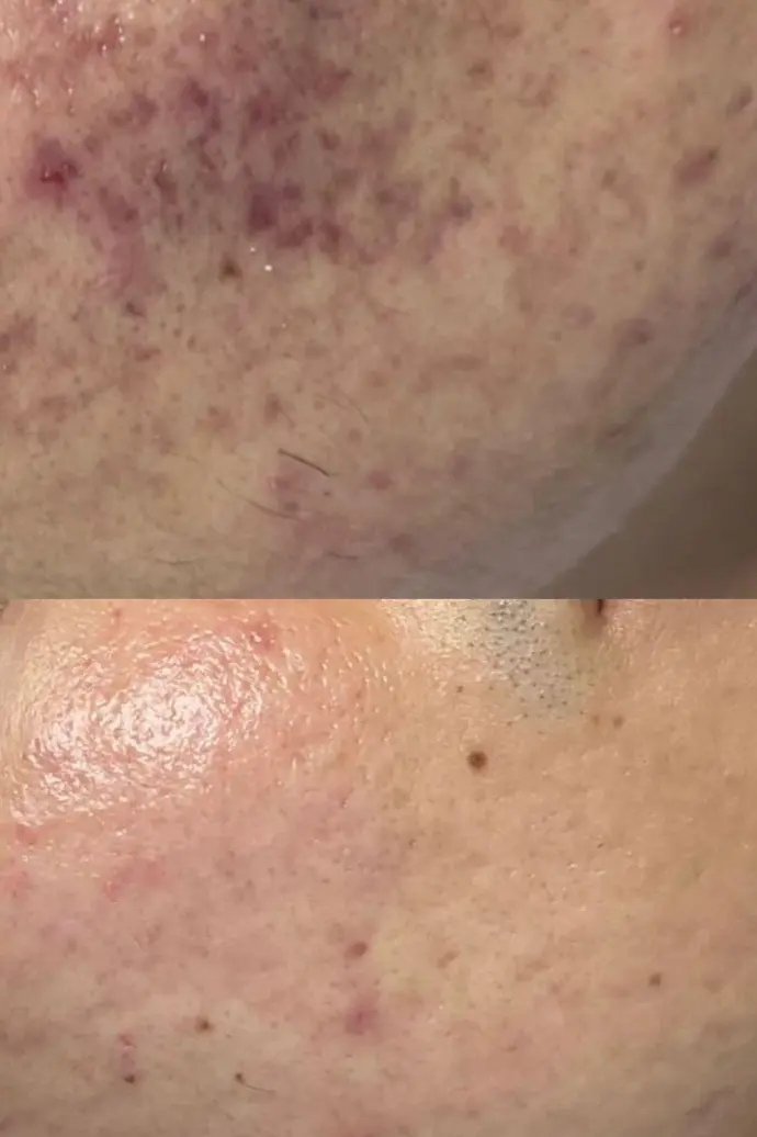 Acne Treatment Acne Treatment